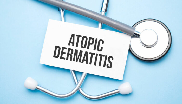 Top 9 Remedies for Atopic Dermatitis